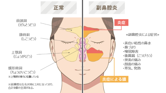 慢性副鼻腔炎 蓄膿症 後鼻漏 痰がからむ 痰が張り付く 西馬込あくつ耳鼻咽喉科 東京都大田区の耳鼻科 アレルギー科